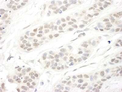 Immunohistochemistry-Paraffin: SET1B Antibody [NBP1-28685] - Sample: FFPE section of human breast carcinoma. Antibody: Affinity purified rabbit anti-hSET1B used at a dilution of 1:1,000 (1ug/ml). Detection: DAB