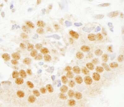 Immunohistochemistry-Paraffin: SETD7 Antibody [NB100-93288] - Sample: FFPE section of human prostate carcinoma. Antibody: Affinity purified rabbit anti- SET7 used at a dilution of 1:1,000 (0.2 ug/ml). Detection: DAB