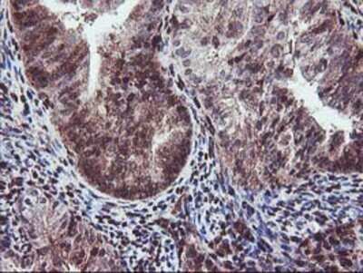 Immunohistochemistry: SETD7 Antibody (OTI2D10) - Azide and BSA Free [NBP2-74145] - Staining of paraffin-embedded Adenocarcinoma of Human endometrium tissue using anti-SETD7 mouse monoclonal antibody.