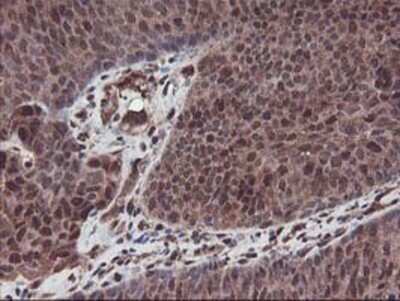 Immunohistochemistry: SETD7 Antibody (OTI2D10) - Azide and BSA Free [NBP2-74145] - Staining of paraffin-embedded Carcinoma of Human bladder tissue using anti-SETD7 mouse monoclonal antibody.