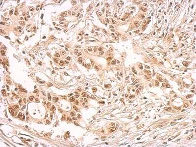 Immunohistochemistry-Paraffin: SF2 Antibody [NBP2-20324] - Antibody detects SFRS1 protein at nucleus on colon carcinoma by immunohistochemical analysis. Sample: Paraffin-embedded colon carcinoma. Antibody dilution: 1:500.