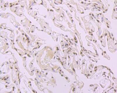 Immunohistochemistry-Paraffin: SF2 Antibody (JB40-76) [NBP2-75663] - Analysis of paraffin-embedded human lung cancer tissue using anti-SF2 antibody. Counter stained with hematoxylin.