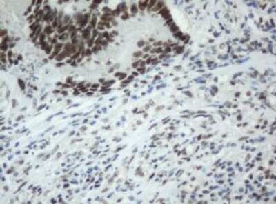 Immunohistochemistry: SF3A1 Antibody (OTI3F4) - Azide and BSA Free [NBP2-74150] - Analysis of Adenocarcinoma of Human colon tissue. (Heat-induced epitope retrieval by 10mM citric buffer, pH6.0, 120C for 3min)