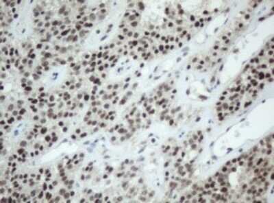 Immunohistochemistry: SF3A1 Antibody (OTI3F4) - Azide and BSA Free [NBP2-74150] - Analysis of Carcinoma of Human pancreas tissue. (Heat-induced epitope retrieval by 10mM citric buffer, pH6.0, 120C for 3min)