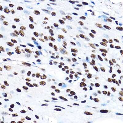 Immunohistochemistry-Paraffin: SF3A3 Antibody [NBP2-94076] - Immunohistochemistry of paraffin-embedded human esophageal cancer using SF3A3 Rabbit pAb (NBP2-94076) at dilution of 1:100 (40x lens). Perform high pressure antigen retrieval with 10 mM citrate buffer pH 6.0 before commencing with IHC staining protocol.