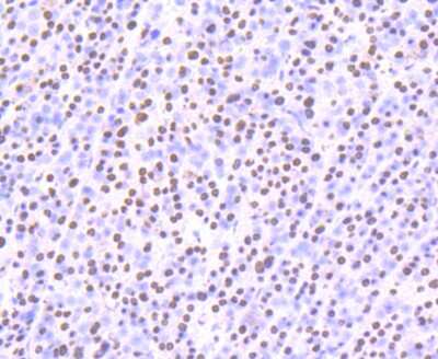 Immunohistochemistry-Paraffin: SFPQ Antibody (JU33-99) [NBP2-75664] - Analysis of paraffin-embedded human liver cancer tissue using anti-SFPQ antibody. Counter stained with hematoxylin.