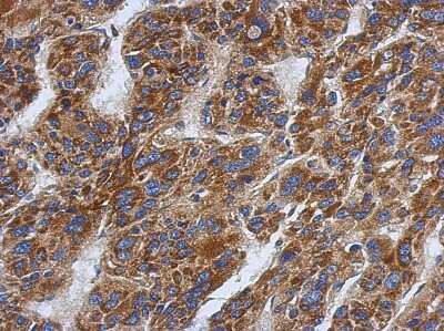 Immunohistochemistry-Paraffin: SFXN1 Antibody [NBP2-20333] - Immunohistochemical analysis of paraffin-embedded Hepatoma, using antibody at 1:500 dilution.