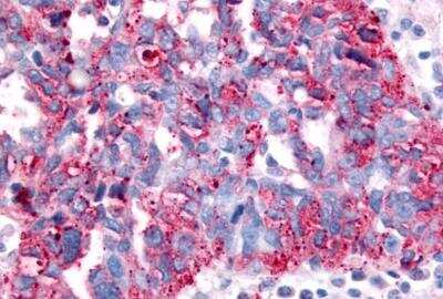 Immunohistochemistry: SGK2 Antibody [NBP2-29393] - Immunohistochemical analysis of carcinoma of the ovary