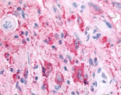 Immunohistochemistry-Paraffin: SGK2 Antibody [NBP2-29393] - Analysis of anti-SGK2 antibody with human brain, glioblastoma.