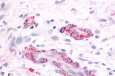 Immunohistochemistry-Paraffin: SGK2 Antibody [NBP2-29393] - Anti-SGK2 antibody IHC of human Brain, Glioblastoma. Immunohistochemistry of formalin-fixed, paraffin-embedded tissue after heat-induced antigen retrieval.