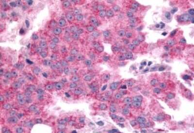 Immunohistochemistry-Paraffin: SGK2 Antibody [NLS7221] - Anti-SGK2 antibody IHC of human Prostate, Carcinoma. Immunohistochemistry of formalin-fixed, paraffin-embedded tissue after heat-induced antigen retrieval.