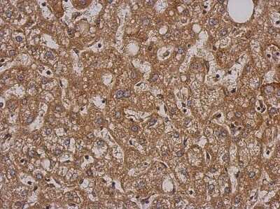 Immunohistochemistry-Paraffin: SH2D3C Antibody [NBP2-20341] - Immunohistochemical analysis of paraffin-embedded Hepatoma, using antibody at 1:500 dilution.