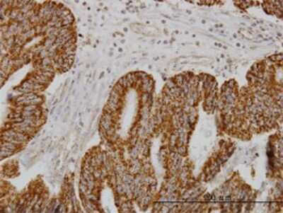 Immunohistochemistry-Paraffin: SH3BP5 Antibody (2B3) [H00009467-M01] - Analysis of monoclonal antibody to SH3BP5 on formalin-fixed paraffin-embedded human colon adenocarcinoma. Antibody concentration 1 ug/ml.
