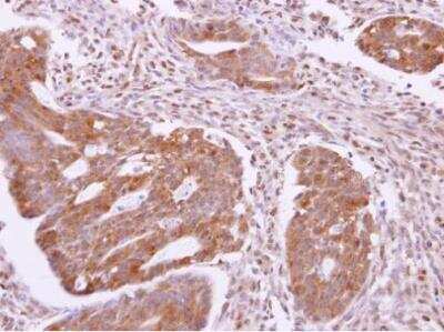 Immunohistochemistry-Paraffin: SH3GLB2 Antibody [NBP2-20346] - Paraffin-embedded colon carcinoma. SH3GLB2 antibody  dilution: 1:500.