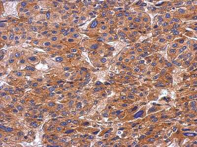 Immunohistochemistry-Paraffin: SH3PX1 Antibody [NBP2-20348] - Immunohistochemical analysis of paraffin-embedded Hepatoma, using antibody at 1:500 dilution.