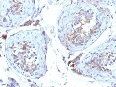 Immunohistochemistry-Paraffin: SHBG Antibody (SHBG/245) - Azide and BSA Free [NBP2-48007] - Human Testicular Carcinoma stained with SHBG Monoclonal Antibody (SHBG/245)