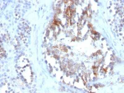 Immunohistochemistry-Paraffin: SHBG Antibody (SPM605) - IHC-Prediluted [NBP2-48426] - Human Testicular Carcinoma stained with SHBG Monoclonal Antibody (SPM605)