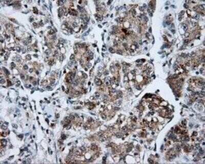 Immunohistochemistry: SHC1 Antibody (OTI3A1) - Azide and BSA Free [NBP2-74167] - Staining of paraffin-embedded Carcinoma of liver tissue using anti-SHC1 mouse monoclonal antibody.