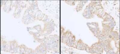 <b>Biological Strategies Validation. </b>Immunohistochemistry: SHIP2/INPPL1 Antibody [NB100-1592] - Sample: FFPE serial sections of human colon carcinoma. Antibody: Affinity purified rabbit anti-expndtw-6 INPPL1/SHIP2 Cat. No. Lot 1 (left) and Lot 2 (right) used at a dilution of 1:1,000 (1ug/ml). Detection: DAB