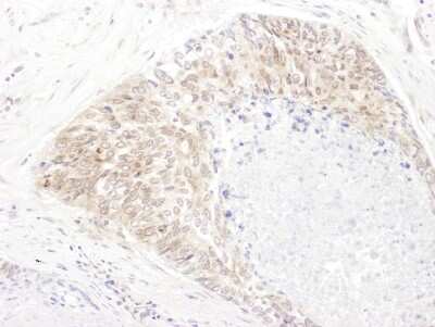 Immunohistochemistry-Paraffin: SHMT1 Antibody [NBP2-32173] - Section of human lung cancer. Antibody: Affinity purified rabbit anti- SHMT1 used at a dilution of 1:1,000 (1ug/ml). Detection: DAB. Counterstain: Hematoxylin (blue).