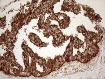 Immunohistochemistry: SHMT2 Antibody (3E9) [NBP2-45826] - Analysis of Adenocarcinoma of Human ovary tissue.(Heat-induced epitope retrieval by 1mM EDTA in 10mM Tris buffer (pH8.5) at 120C for 3 min)