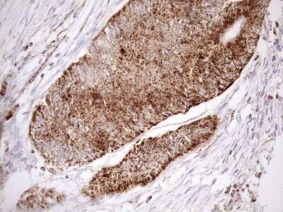 Immunohistochemistry: SHMT2 Antibody (OTI3E9) - Azide and BSA Free [NBP2-74171] - Analysis of Adenocarcinoma of Human colon tissue. (Heat-induced epitope retrieval by 1mM EDTA in 10mM Tris buffer (pH8.5) at 120C for 3 min)