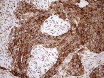 Immunohistochemistry: SHMT2 Antibody (OTI3E9) - Azide and BSA Free [NBP2-74171] - Analysis of Adenocarcinoma of Human endometrium tissue. (Heat-induced epitope retrieval by 1mM EDTA in 10mM Tris buffer (pH8.5) at 120C for 3 min)(1:150)