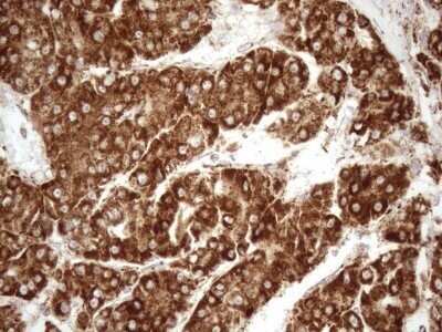 Immunohistochemistry: SHMT2 Antibody (OTI3E9) - Azide and BSA Free [NBP2-74171] - Analysis of Carcinoma of Human liver tissue.(Heat-induced epitope retrieval by 1mM EDTA in 10mM Tris buffer (pH8.5) at 120C for 3 min)