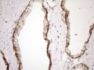 Immunohistochemistry: SHMT2 Antibody (OTI3E9) - Azide and BSA Free [NBP2-74171] - Analysis of Carcinoma of Human prostate tissue. (Heat-induced epitope retrieval by 1mM EDTA in 10mM Tris buffer (pH8.5) at 120C for 3 min)