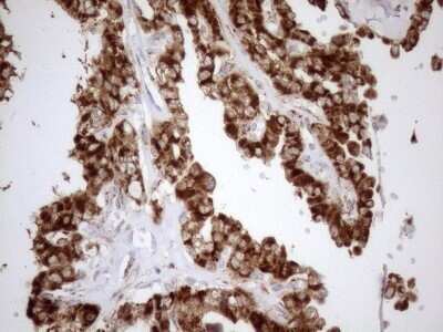 Immunohistochemistry: SHMT2 Antibody (OTI3E9) - Azide and BSA Free [NBP2-74171] - Analysis of Carcinoma of Human thyroid tissue. (Heat-induced epitope retrieval by 1mM EDTA in 10mM Tris buffer (pH8.5) at 120 for 3 min)