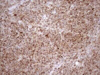 Immunohistochemistry: SHMT2 Antibody (OTI3E9) - Azide and BSA Free [NBP2-74171] - Analysis of Human lymphoma tissue. (Heat-induced epitope retrieval by 1mM EDTA in 10mM Tris buffer (pH8.5) at 120C for 3 min)