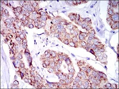 Immunohistochemistry-Paraffin: SHP-2/PTPN11 Antibody (6D9) [NBP2-37454] - Analysis of breast cancer tissues using PTPN11 mouse mAb with DAB staining.