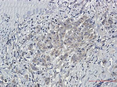 Immunohistochemistry-Paraffin: SHP-2/PTPN11 Antibody (S08-3G2) [NBP3-19502] - Immunohistochemistry of SHP-2/PTPN11 in paraffin-embedded Human breast cancer tissue using NBP3-19502 at dilution 1/50