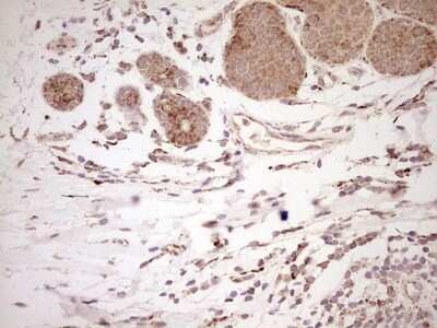 Immunohistochemistry: SHP/NR0B2/Nuclear Receptor SHP Antibody (7B5) [NBP2-46522] - Analysis of Adenocarcinoma of Human breast tissue. (Heat-induced epitope retrieval by Tris-EDTA, pH8.0) .