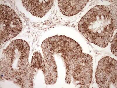 Immunohistochemistry: SHP/NR0B2/Nuclear Receptor SHP Antibody (7B5) [NBP2-46522] - Analysis of Adenocarcinoma of Human colon tissue. (Heat-induced epitope retrieval by Tris-EDTA, pH8.0) Dilution: 1:150