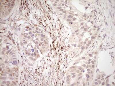 Immunohistochemistry: SHP/NR0B2/Nuclear Receptor SHP Antibody (7B5) [NBP2-46522] - Analysis of Carcinoma of Human kidney tissue. (Heat-induced epitope retrieval by Tris-EDTA, pH8.0)