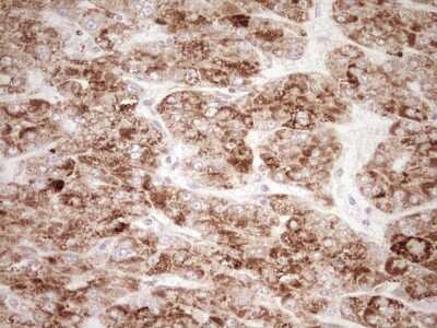 Immunohistochemistry: SHP/NR0B2/Nuclear Receptor SHP Antibody (7B5) [NBP2-46522] - Analysis of Carcinoma of Human liver tissue. (Heat-induced epitope retrieval by Tris-EDTA, pH8.0)