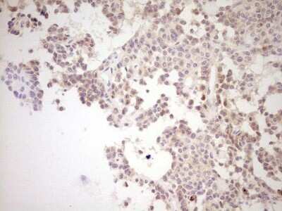 Immunohistochemistry: SHP/NR0B2/Nuclear Receptor SHP Antibody (7B5) [NBP2-46522] - Analysis of Carcinoma of Human lung tissue. (Heat-induced epitope retrieval by Tris-EDTA, pH8.0)