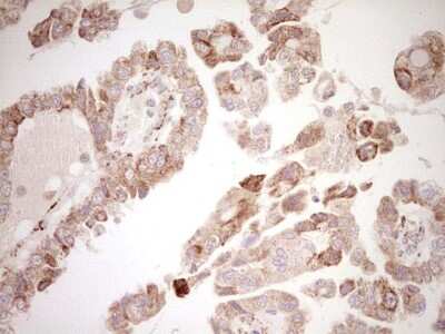 Immunohistochemistry: SHP/NR0B2/Nuclear Receptor SHP Antibody (7B5) [NBP2-46522] - Analysis of Adenocarcinoma of Human ovary tissue. (Heat-induced epitope retrieval by Tris-EDTA, pH8.0)