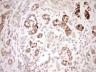 Immunohistochemistry: SHP/NR0B2/Nuclear Receptor SHP Antibody (7B5) [NBP2-46522] - Analysis of Carcinoma of Human pancreas tissue. (Heat-induced epitope retrieval by Tris-EDTA, pH8.0)