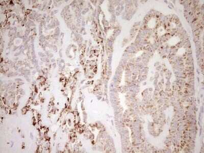 Immunohistochemistry: SHP/NR0B2/Nuclear Receptor SHP Antibody (7B5) [NBP2-46522] - Analysis of Carcinoma of Human thyroid tissue. (Heat-induced epitope retrieval by Tris-EDTA, pH8.0)