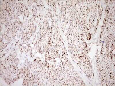 Immunohistochemistry: SHP/NR0B2/Nuclear Receptor SHP Antibody (7B5) [NBP2-46522] - Analysis of Adenocarcinoma of Human endometrium tissue. (Heat-induced epitope retrieval by Tris-EDTA, pH8.0)