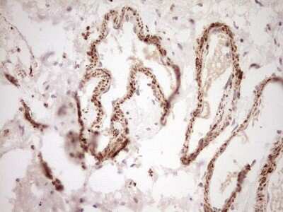 Immunohistochemistry: SHP/NR0B2/Nuclear Receptor SHP Antibody (7B5) [NBP2-46522] - Analysis of Carcinoma of Human bladder tissue. (Heat-induced epitope retrieval by Tris-EDTA, pH8.0)