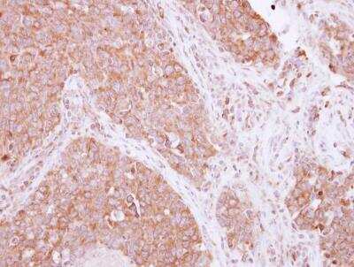 Immunohistochemistry-Paraffin: SIAH1 Antibody [NBP2-20356] - Human lung Papillary adenocarcinoma, using SIAH1 antibody at 1:250 dilution. Antigen Retrieval: Trilogy™ (EDTA based, pH 8.0) buffer, 15min.