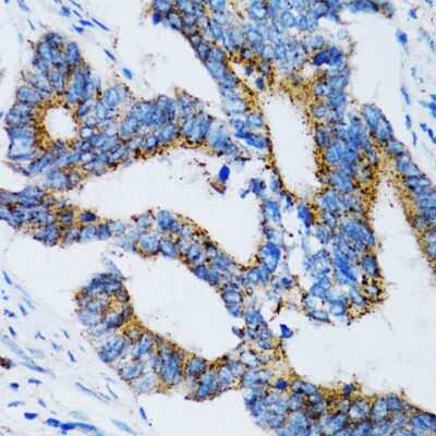 Immunohistochemistry-Paraffin: SIAH1 Antibody [NBP2-93864] - Human colon carcinoma using SIAH1 antibody at dilution of 1:100 (40x lens).Perform microwave antigen retrieval with 10 mM PBS buffer pH 7.2 before commencing with IHC staining protocol.