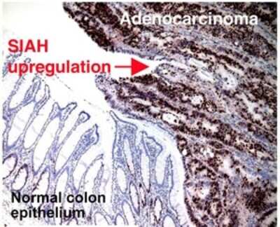 Immunohistochemistry: SIAH2 Antibody (24E6H3) [NB110-88113] - Staining of SIAH in human colorectal adenocarcinoma using NB110-88113. Staining of SIAH was not observed in normal colon epithelium. Photos courtesy of Dr. Amy Tang, Mayo Clinic Cancer Center.