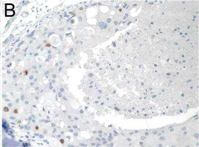 Immunohistochemistry: SIAH2 Antibody (24E6H3) [NB110-88113] - Moderate to strong staining of SIAH2 in the nucleus of a small proportion of the cell in a high nuclear grade ductal carcinoma in situ with comedo necrosis. Image collected and cropped by CiteAb from the following publication (breast-cancer-research.biomedcentral.com/articles/10.1186/bcr2828), licensed under a CC-BY license.