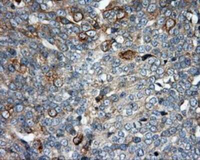 Immunohistochemistry-Paraffin: SIL1 Antibody (3E3) [NBP2-02377] - Staining of paraffin-embedded Adenocarcinoma of ovary tissue using anti-SIL1 mouse monoclonal antibody.