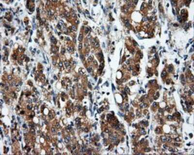 Immunohistochemistry-Paraffin: SIL1 Antibody (3E3) [NBP2-02377] - Staining of paraffin-embedded Carcinoma of liver tissue using anti-SIL1 mouse monoclonal antibody.