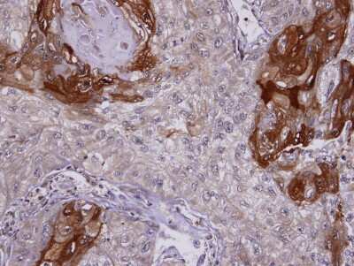 Immunohistochemistry-Paraffin: SIL1 Antibody [NBP2-20363] - Immunohistochemical analysis of paraffin-embedded TW2. 6 xenograft, using antibody at 1:100 dilution.